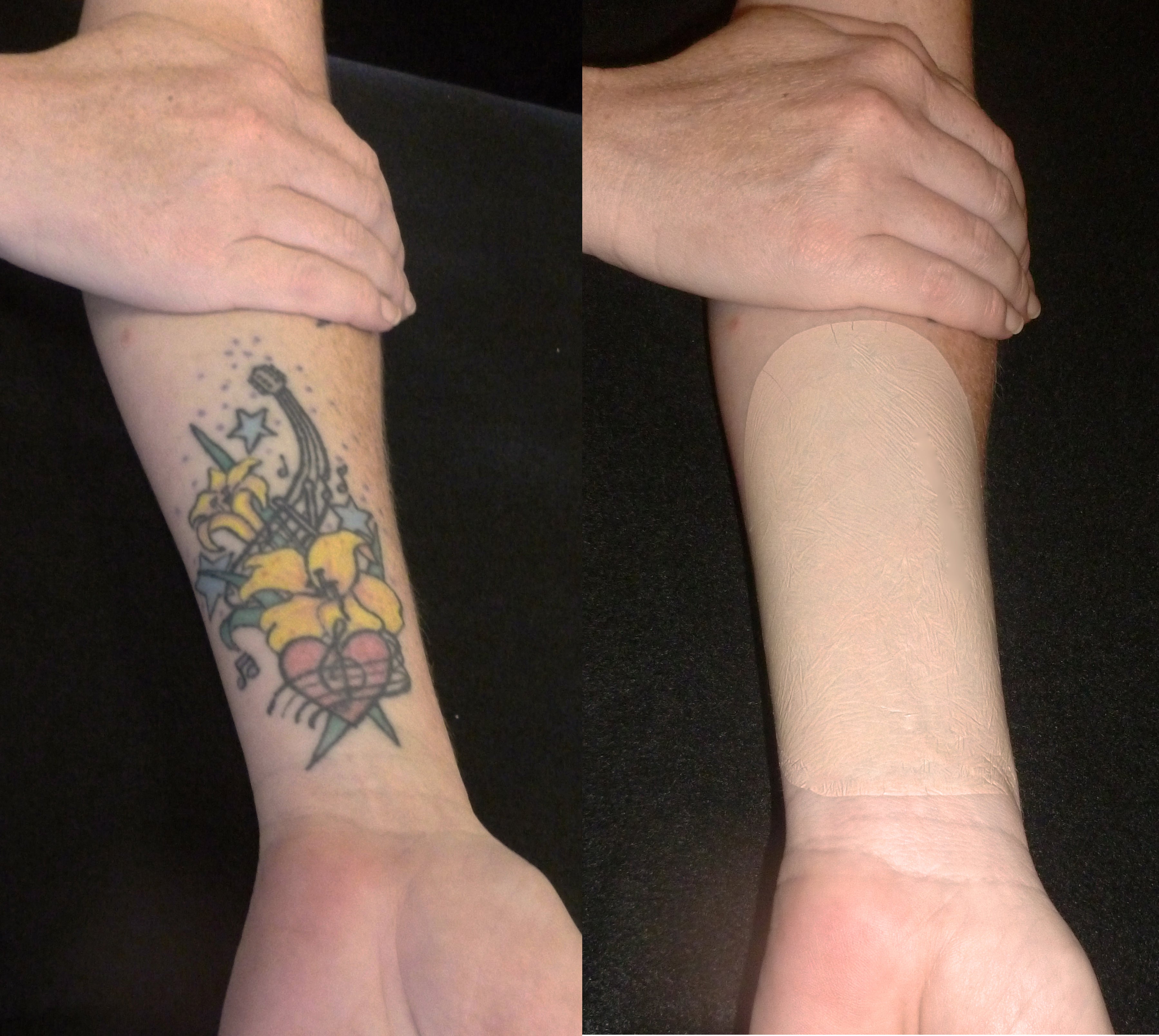 Tattoo Coverups and Tattoo Concealing